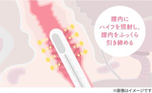 若い女性が膣のサイズが縮小になった理由とは、